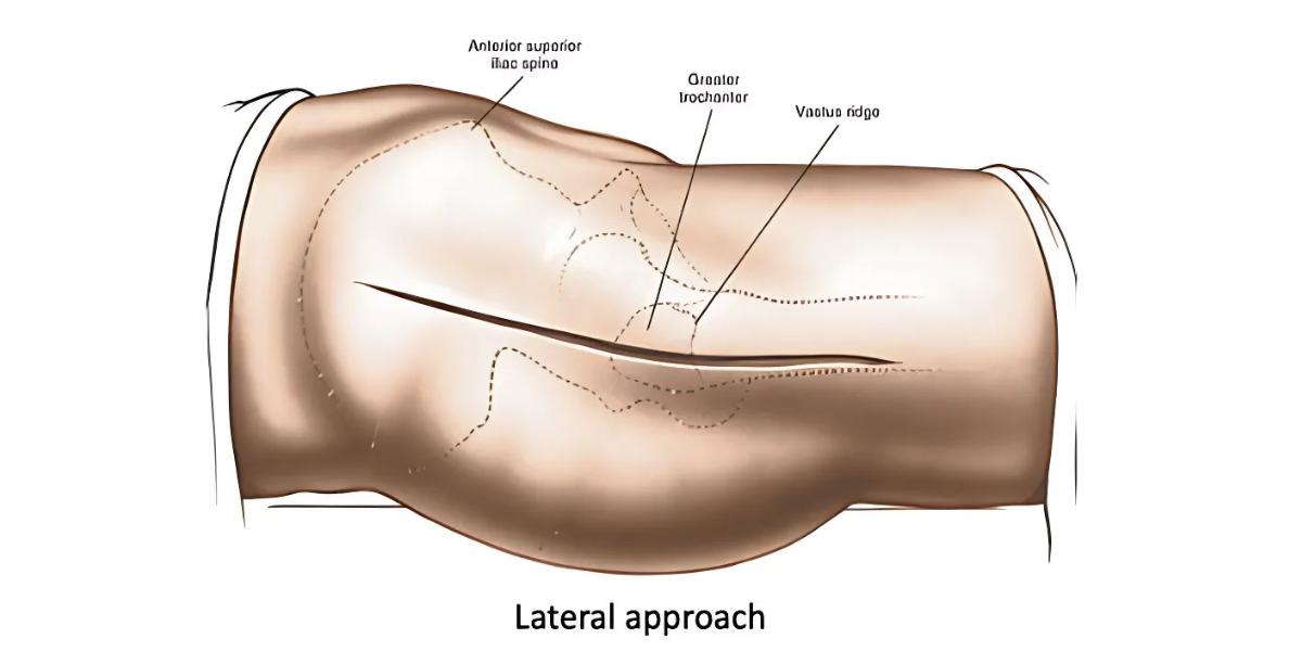 Lateral Approach