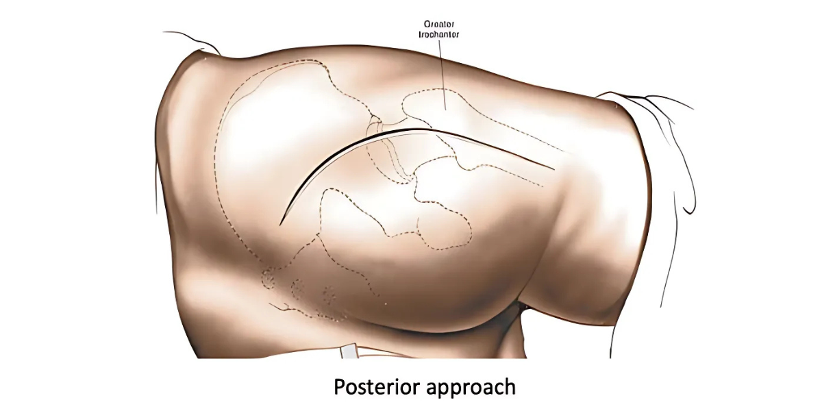 Posterior Approach