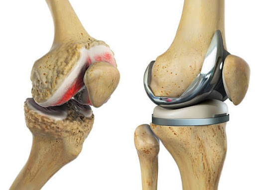 What is Total Knee Replacement Surgery?