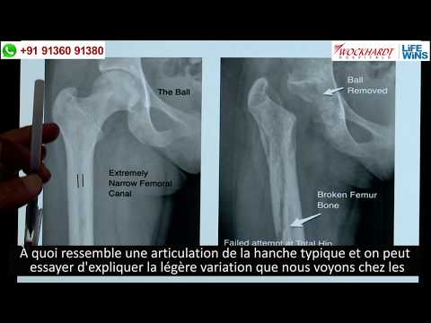 Total Hip Replacement Surgery | 22 yrs from Niger, West Africa | Wockhardt Hospitals, Mumbai, India